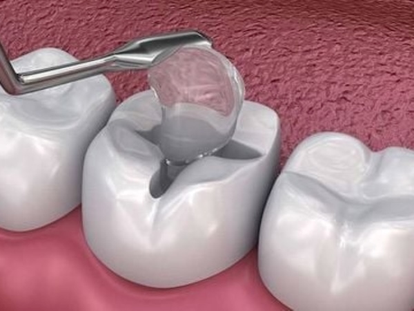 Trám răng tạm thời có bền hay không?