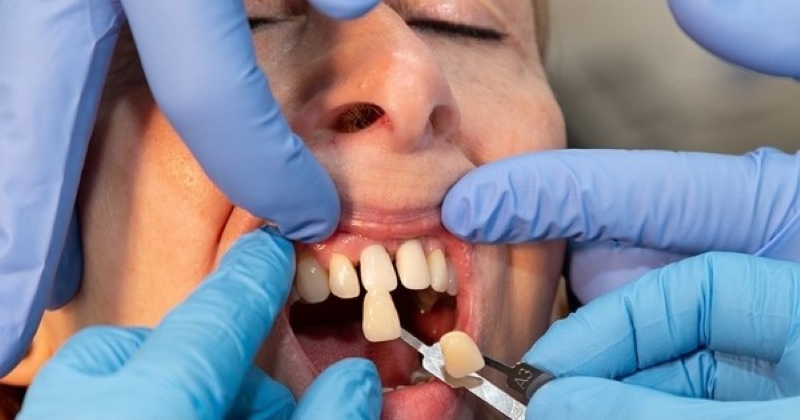 Nguy cơ tiềm ẩn sau khi bọc răng sứ Nguy cơ tiềm ẩn sau khi bọc răng sứ