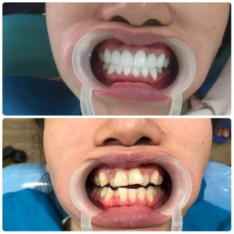 Mài răng bọc sứ không ảnh hưởng đến sức khỏe