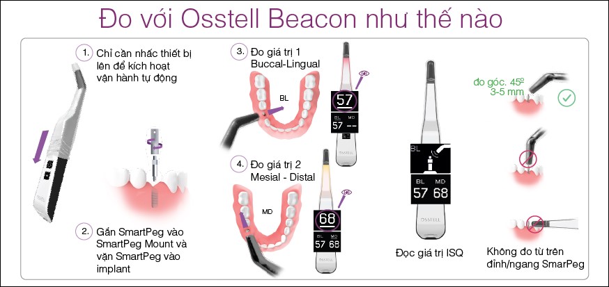 Các thiết bị cần thiết để đo độ vững ổn Implant 