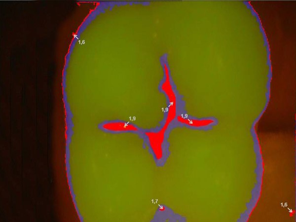 Chẩn đoán kỹ thuật số để phát hiện các tổn thương ở đường gân