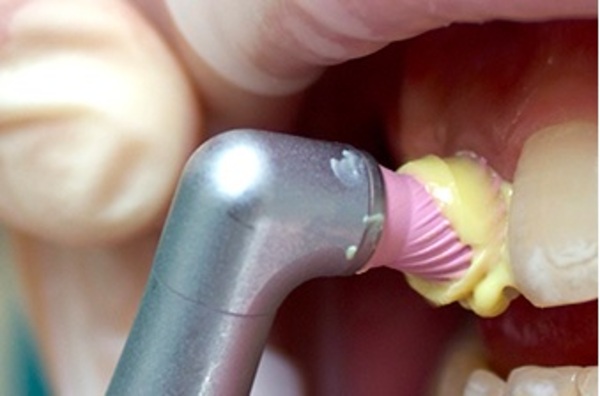 cạo vôi và đánh bóng răng