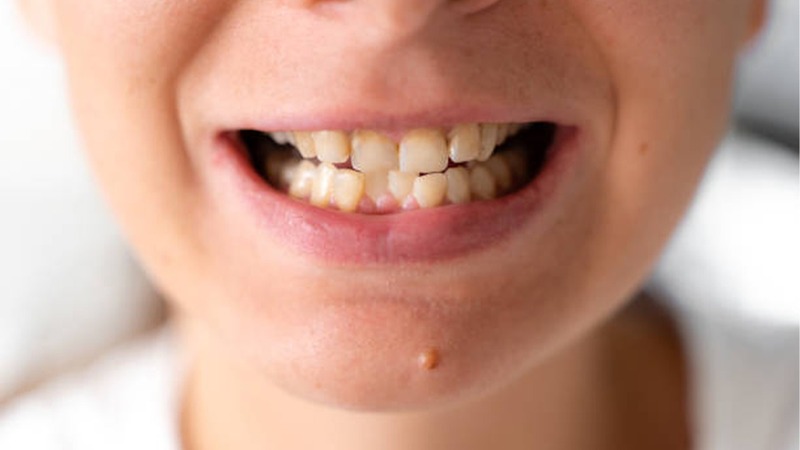 Răng khấp khểnh gây khó khăn trong quá trình vệ sinh răng miệng hàng ngày