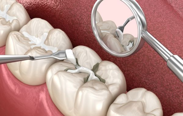 Phục hình răng bằng trám sứ thông qua vật liệu phục hình CAD CAM VITA