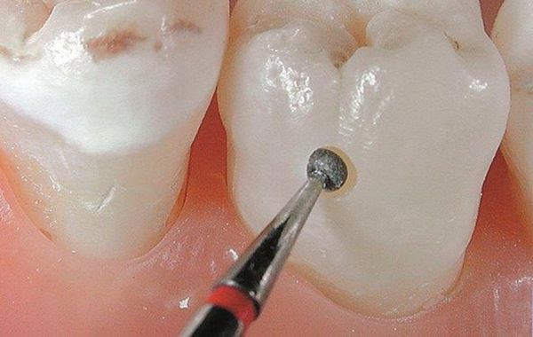 Cần tiệt trùng khuẩn mũi khoan nha khoa sau khi dùng để tránh nhiễm khuẩn