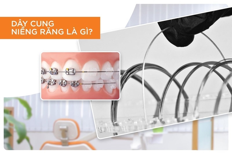 Dây cung niềng răng có những loại nào? Có tác dụng gì?