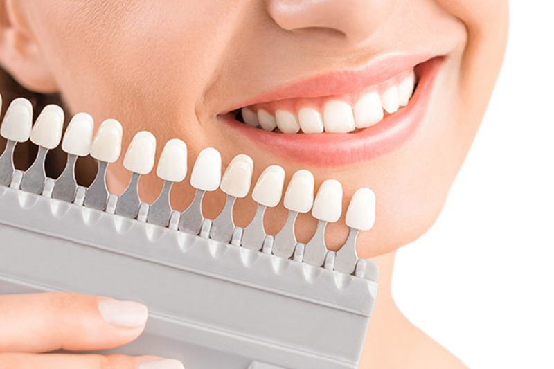 Làm răng thẩm mỹ trắng sáng tự nhiên hay trắng “vô hồn”?