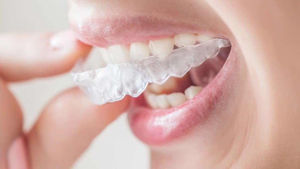 Tại sao nên chọn phương pháp niềng răng không mắc cài Clear Aligner