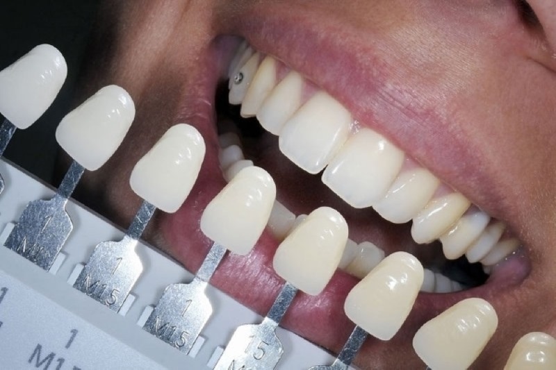 Ưu nhược điểm của việc bọc răng sứ? Lời khuyên từ chuyên gia